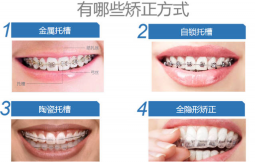 钴铬烤瓷牙能做ct吗（镶了烤瓷牙能做*部CT吗）